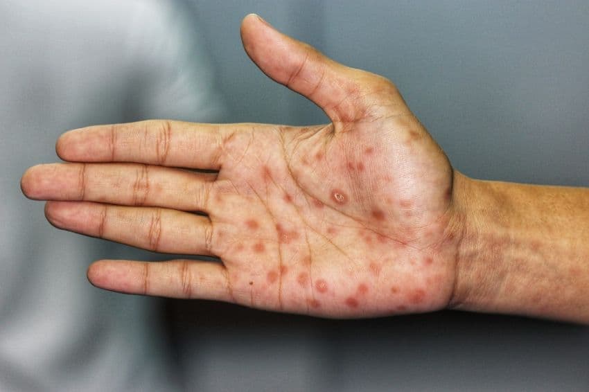 Dokter Berupaya Tingkatkan Kesadaran akan Lonjakan Kasus Sifilis di Jepang
